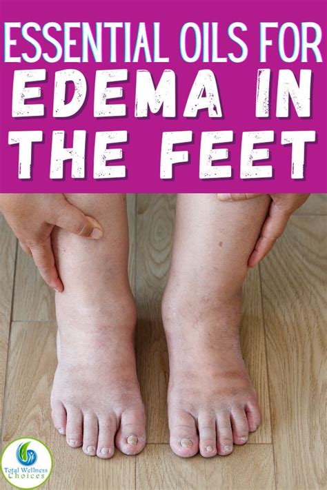 Top 5 Essential Oils For Swollen Feet And Ankles Essential Oil For