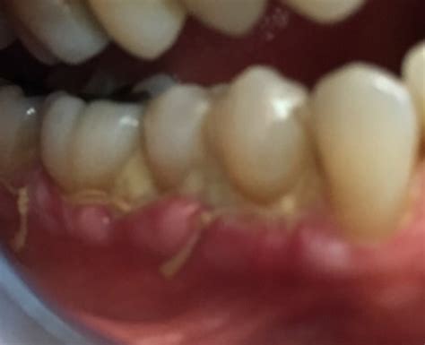 One Week After Gum Graft Menlo Park Dental Excellence