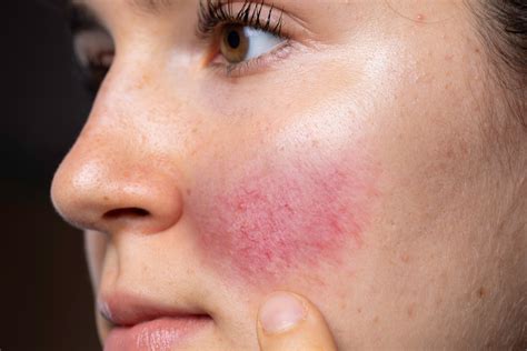 What Is Rosacea And How Is It Treated Mirabile