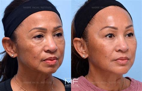 Jawline Contouring With Filler For San Francisco Bay Area