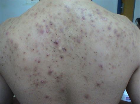 Diseases Of The Sebaceous Glands Acne Cystic Picture Hellenic