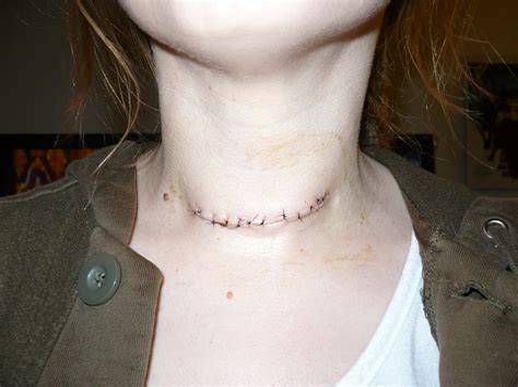 Parathyroidectomy Surgery Scar I Had My Parathyroid Glands Flickr