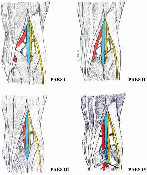 Classification Of Popliteal Artery Entrapment Syndrome Paes