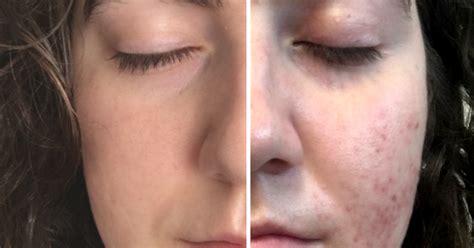 Tretinoin Retin A Before And After Acne Katie Mcmanus