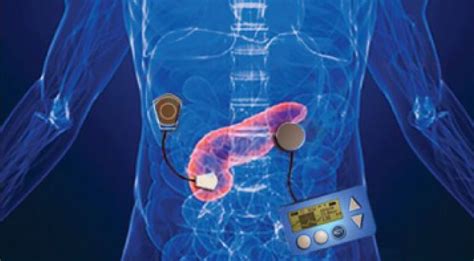 The Bionic Pancreas Harbinger Of A New Era In Organ Replacement