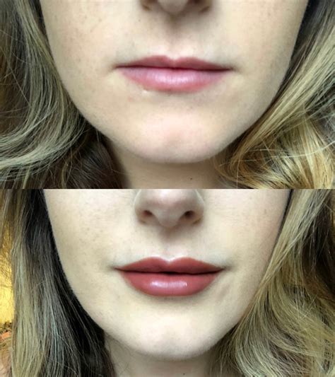 2ml Lip Filler Before And After