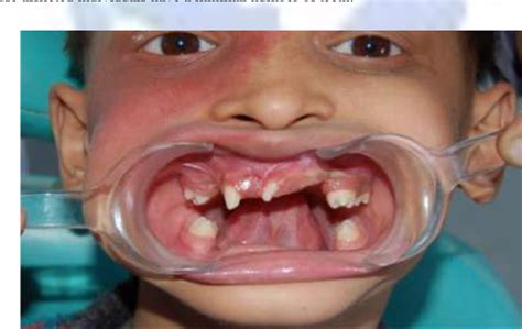 Figure From Anhidrotic Ectodermal Dysplasia The Dental Perspective A Case Report