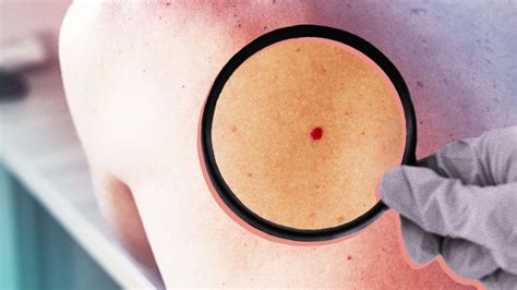 Red Moles Causes And Treatment Of Cherry Angiomas