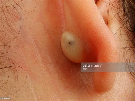 Sebaceous Cyst Sebaceous Cyst Behind The Ear Nachrichtenfoto Getty