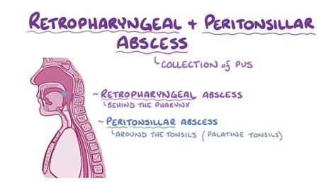 Retropharyngeal And Peritonsillar Abscesses Video Osmosis