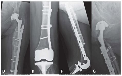 Fixation Of Periprosthetic Fractures Aboutbelow Total Hip Arthroplasty