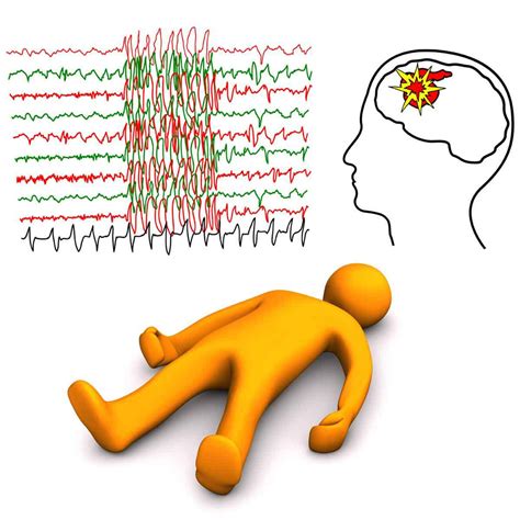 What Is Epilepsy Symptoms Causes Types How To Improve The