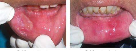 Figure 3 From Recurrent Aphthous Stomatitis Current Concepts In Diagnosis And Management