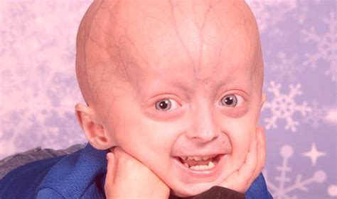 Progeria Life Expectancy Facts Symptoms Causes Treatment