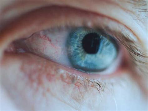 Episcleritis Symptoms Causes And Treatment