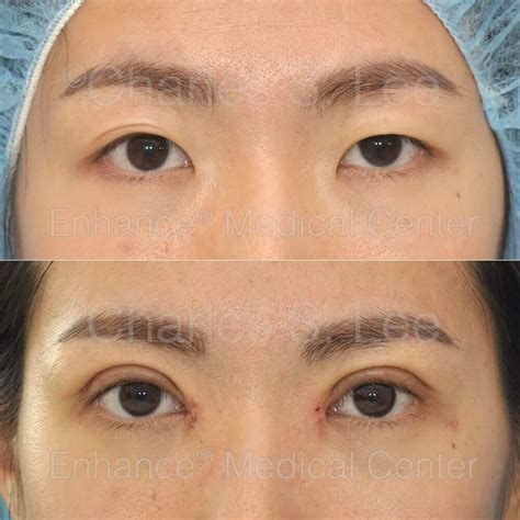 Asian Eye Cosmetic Surgery