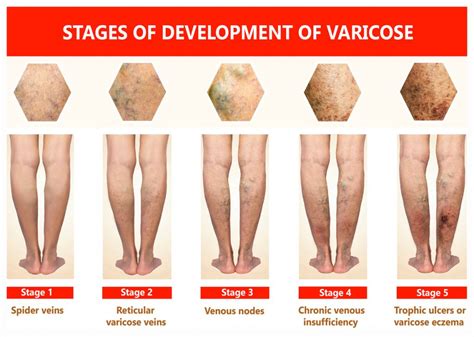 What Is Venous Ulcer Disease A Doctor S Guide Vein Vascular Institute