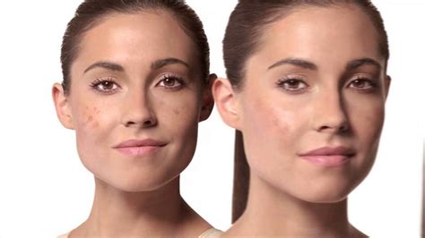 Sun Damage Causes Dark Spots On Face How To Protect Youtube