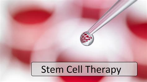 Stem Cell Therapy Wisata Ukraina