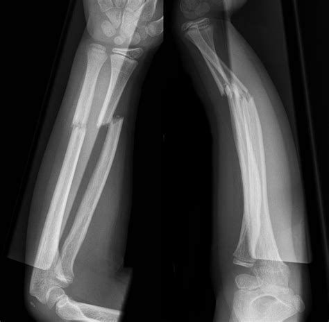 Fractures Forearm
