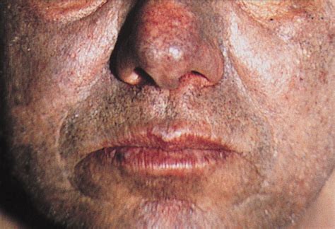 Extensive Bluish Gray Skin Pigmentation And Severe Arthropathy