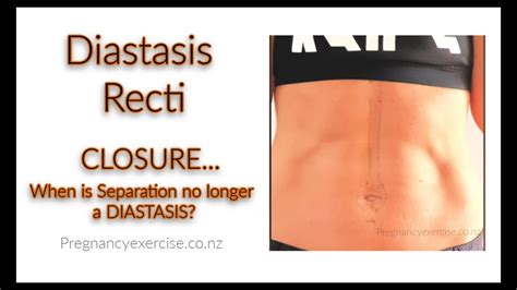 Diastasis Recti Closurewhen Is Separation No Longer A Diastasis