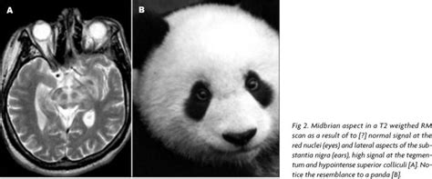 Wilsons Disease Face Of Giant Panda