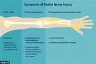 Radial Nerve Pain: Causes and Treatments