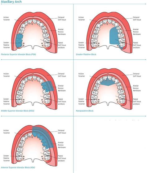 Maxillary Injection Sites Dental Hygenist Dental Anatomy Dental