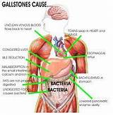 Pictures of How To Manage Gallstone Pain