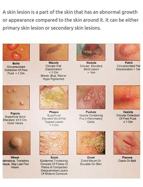 Primary Skin Lesions Naturalskins