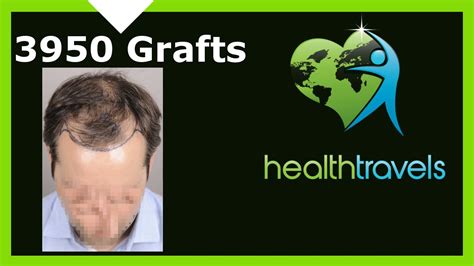 Crown hair transplant before and after. Hair Transplant | Before & After | Front and Crown area ...