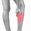 Lower Leg Pain Trigger Point Referrals West Suburban Relief