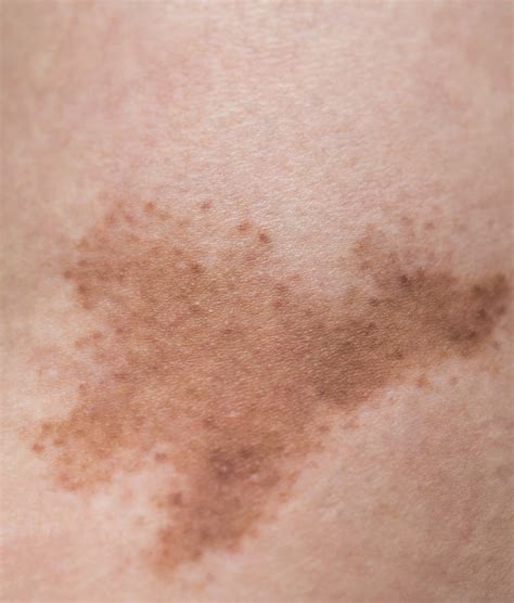Skin Hyperpigmentation Causes Treatments Eruptingmind