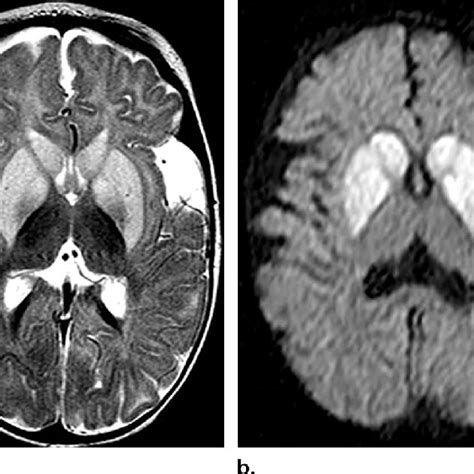Ga1 In A 7 Month Old Infant With Acute Onset Dystonia A Axial