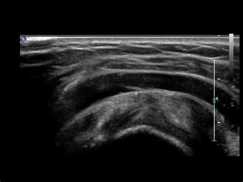 Subdeltoid Bursitis Ultrasound