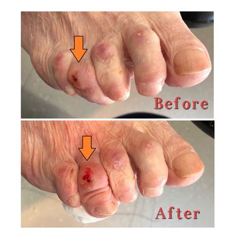 Digital Deformities Mallet Toe Claw Toe Hammer Toe Ankle Foot