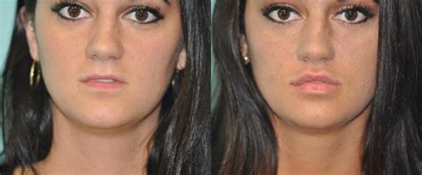 Lip Augmentation Photos Chevy Chase Md Patient 11907