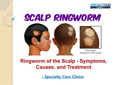 Ringworm Of The Scalp Symptoms Causes And Treatment By Specialty