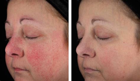 Rosacea Laser Treatment How To Tame Physical Symptoms And Control The