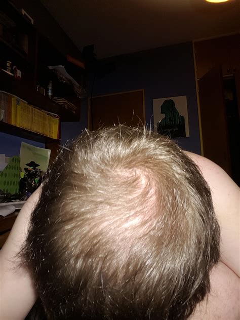 Hello, i am from Buenos Aires and i think i'm suffering of hairloss. My hair isnt thick, and it 
