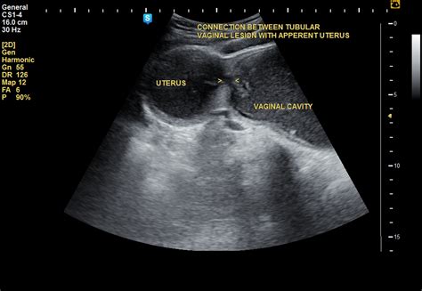 imperforate hymen with hematometrocolpos image