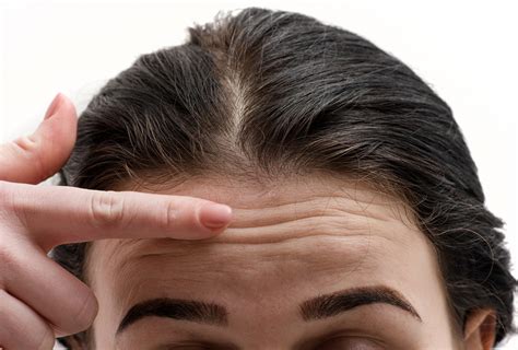 Possible Reasons For Forehead Wrinkles And Treatment Options