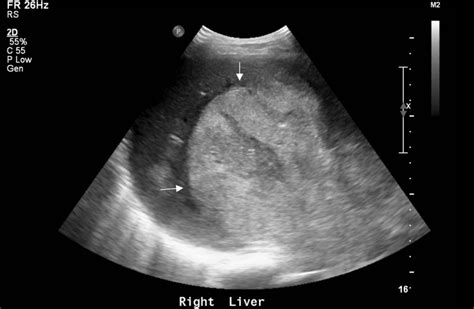 Large Hepatocellular Carcinoma On Ultrasound Radrounds Radiology Network