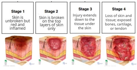 Patient Education Pressure Ulcers Injuries