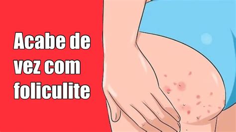 Se Livra De Vez Com Suas Foliculite No Bumbum Pernas E Costa Na Primeira Semana Youtube