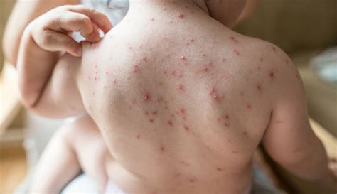 Chickenpox Causes Symptoms Treatment Prevention
