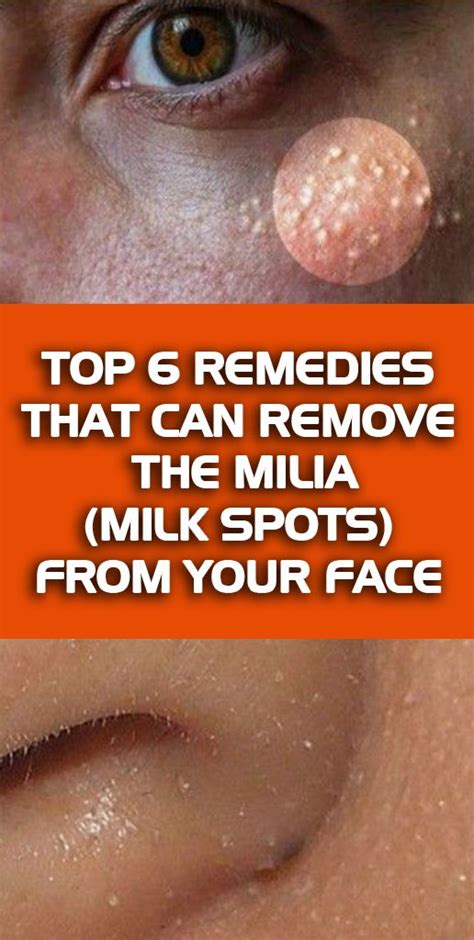 Top 6 Remedies That Can Remove The Milia Milk Spots From Your Face