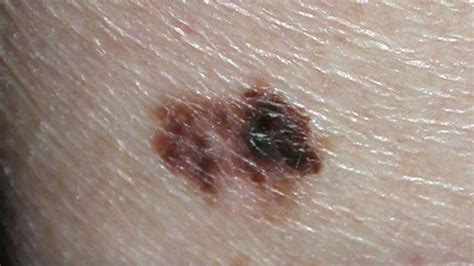 Discolored Skin Patches Pictures Causes And Treatments