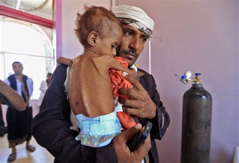 منظمات دولية نصف مليون مصاب بسوء التغذية في اليمن أخبار السعودية صحيفة عكاظ